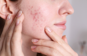 adult acne