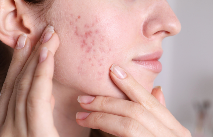 adult acne